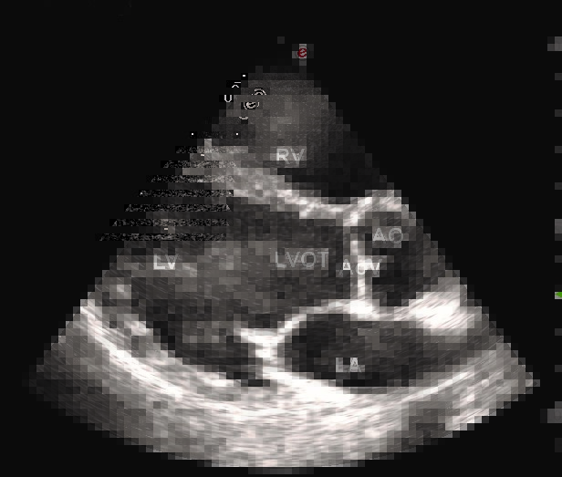 Echocardiogram of the heart